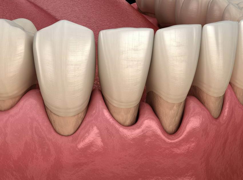 Причины клиновидного дефекта зубов