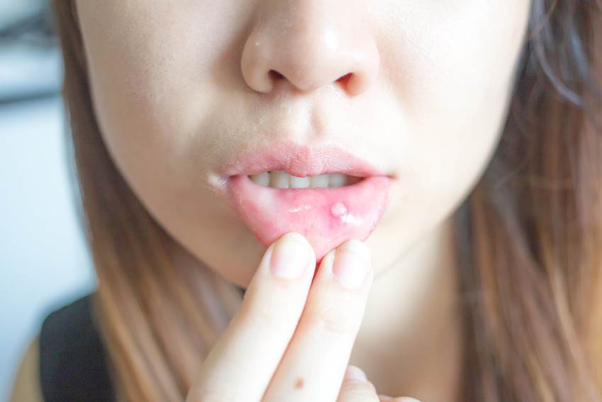 Частые причины образования шишки во рту