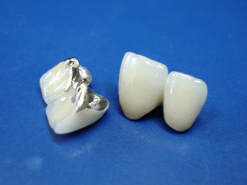 На что можно поставить металлокерамический зуб