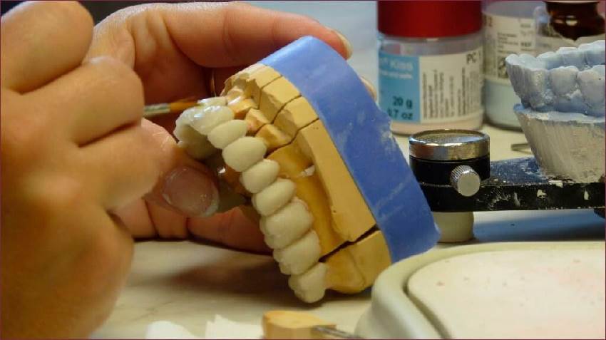 Процедура изготовления и установки металлокерамического зуба
