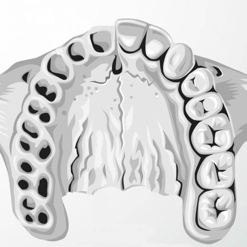 Сохранение альвеолы после удаления зуба
