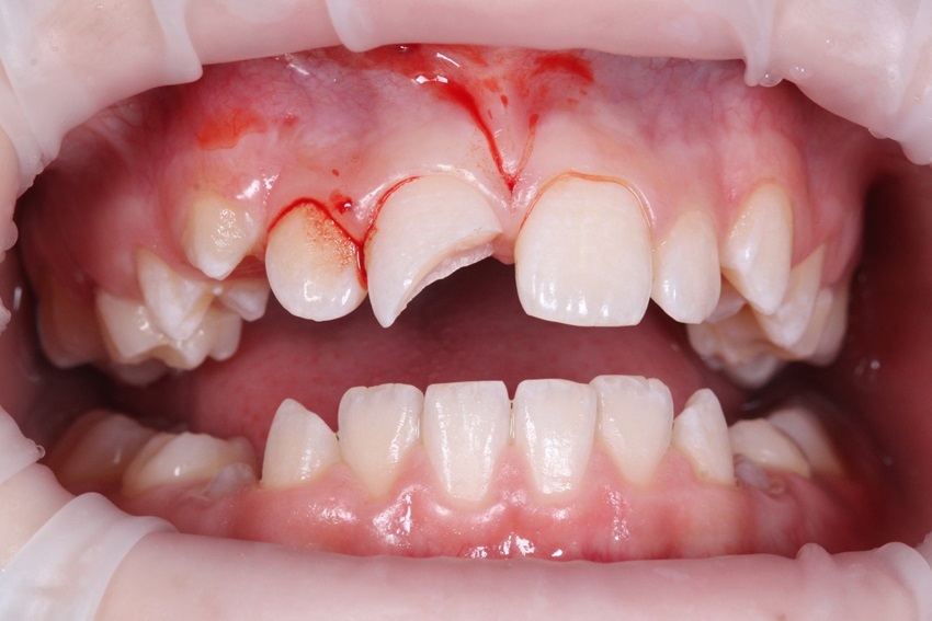 Особенности травмы зуба