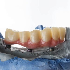 Отсутствие нижних зубов: последствия и способы лечения