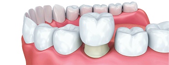 Коронки на жевательные зубы: как выбрать оптимальный вариант?