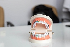 Как выпрямить зубы: показания, преимущества