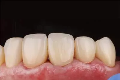 Сняты старые коронки, установлены новые керамические E-max
