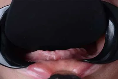 Имплантация all-on-4. Все зубы восстановлены