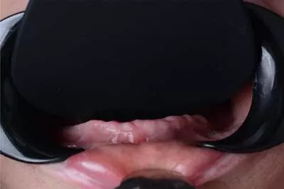 Имплантация all-on-4. Все зубы восстановлены