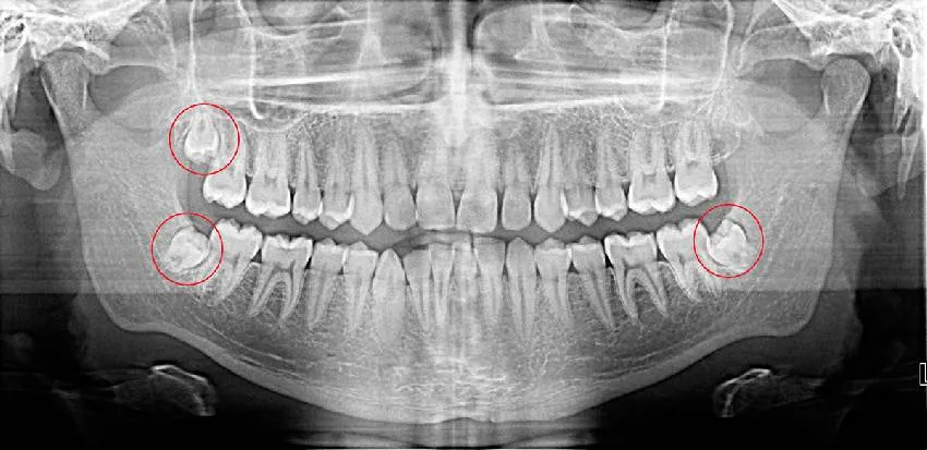 Зачатки зубов мудрости