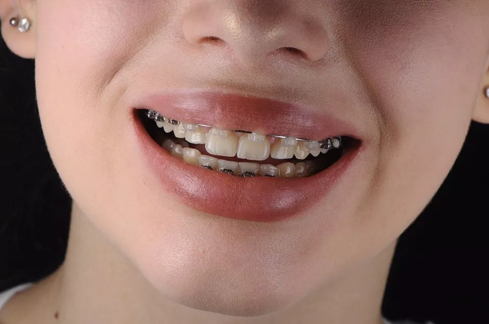 Керамические брекеты в Солнцево