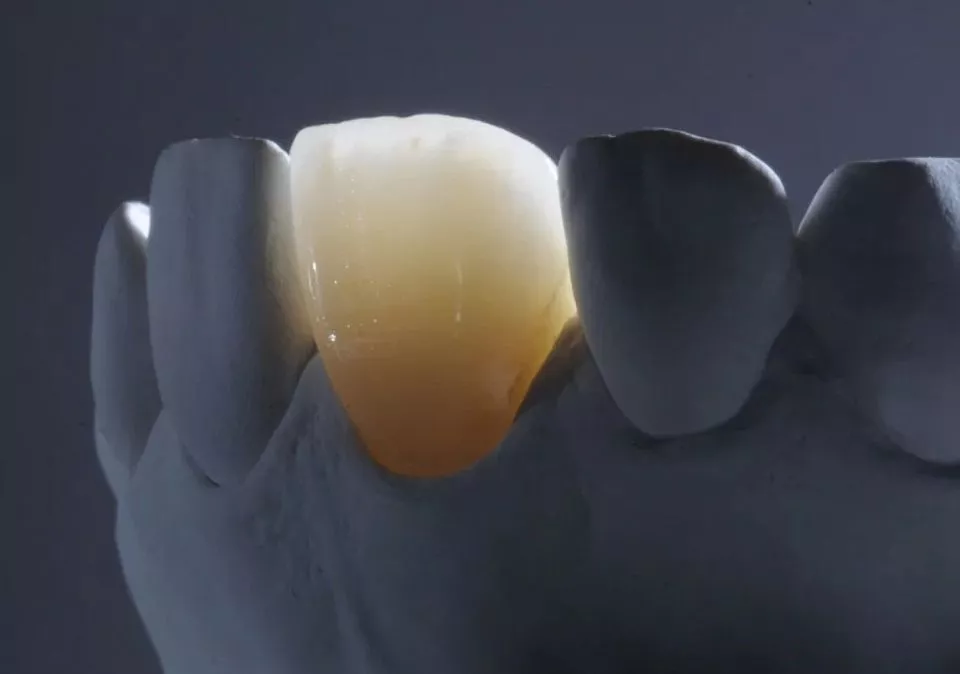 Керамическая коронка E-max в Мытищах