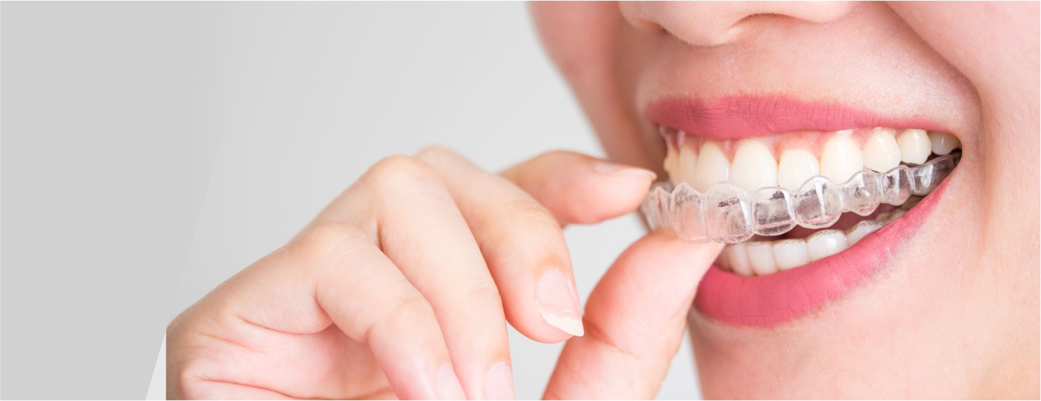 Зубы после брекетов, что происходит после снятия брекет системы?