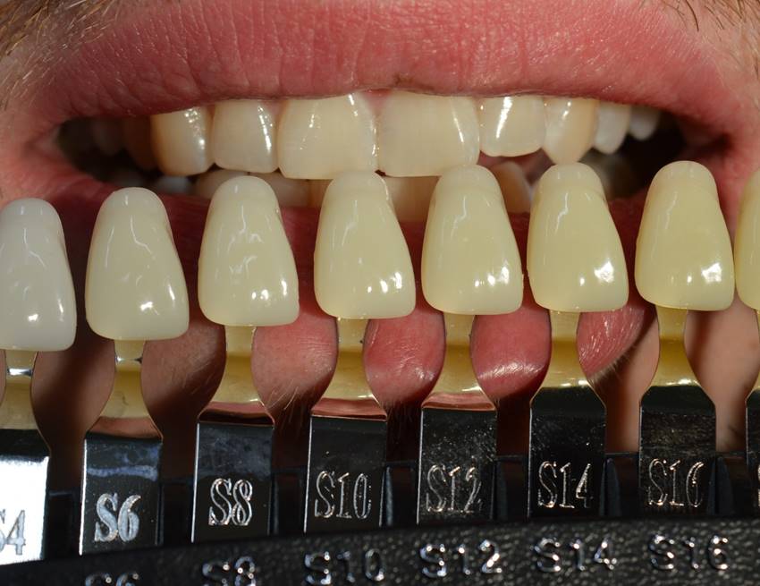 Причины желтого налета на зубах