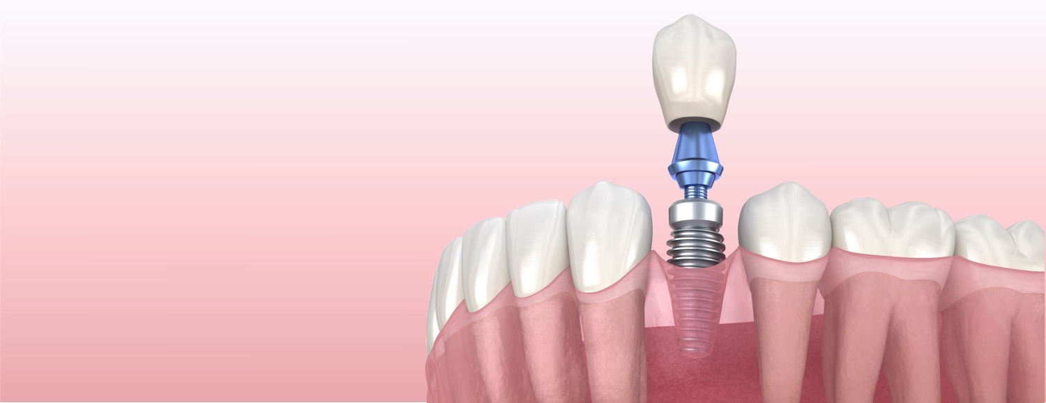 Одноэтапная имплантация зубов: быстрое восстановление услыбки