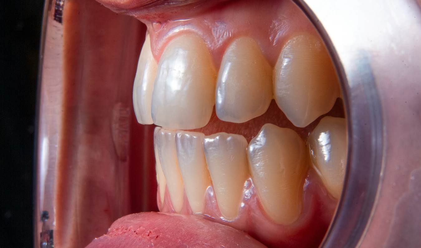 Полировка зубов: показания, противопоказания, процедура