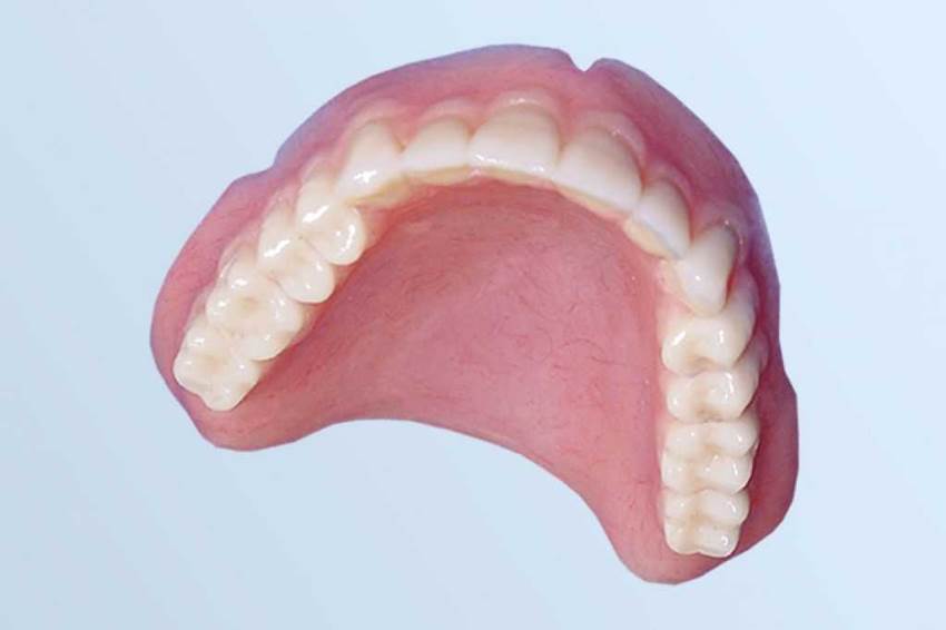 Имплантация нижних передних зубов