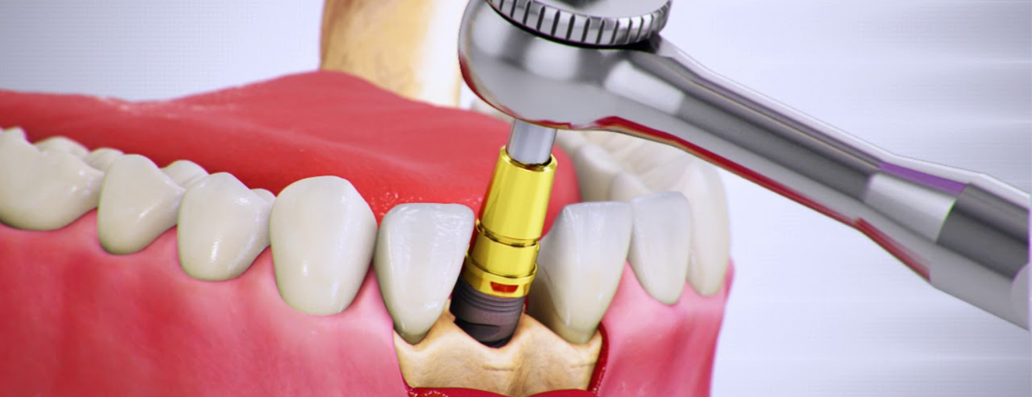Классическая двухэтапная имплантация зубов: особенности и этапы