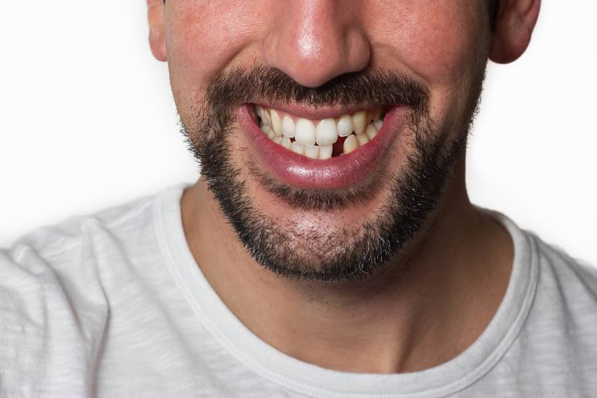 Причины выпадения зубов у взрослых