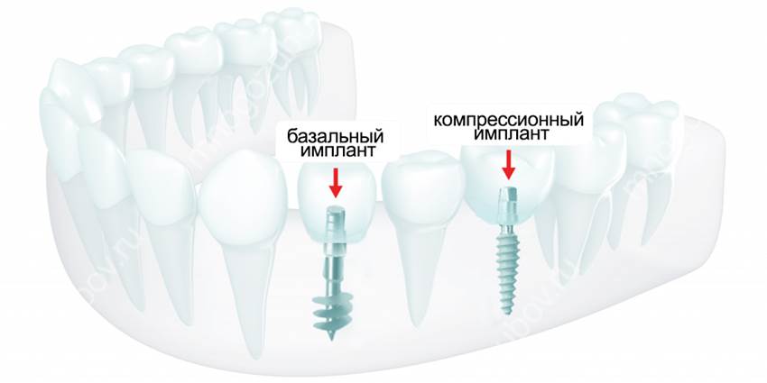 Часто задаваемые вопросы о базальной имплантации зубов