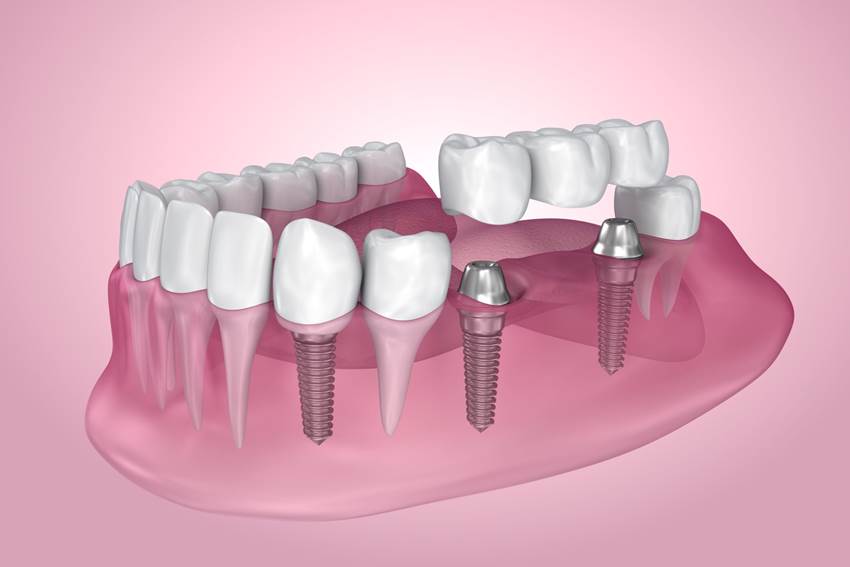Прибегнуть к имплантации зубов вместо съемного протеза