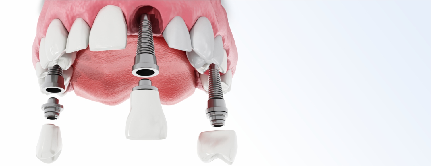 Имплантация верхних зубов: особенности операции