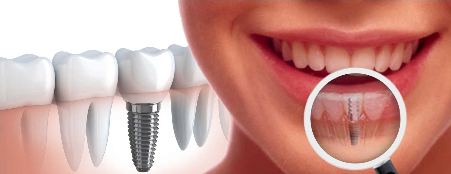 Одномоментная имплантация зубов: преимущества и недостатки