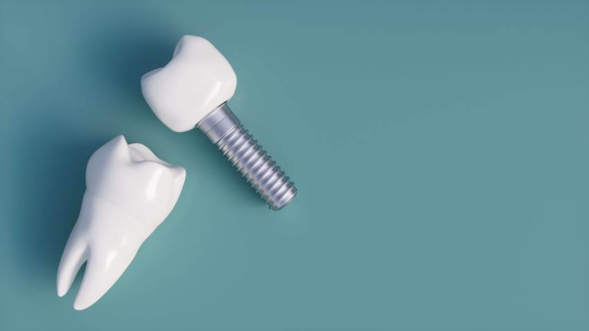 Симптомы и признаки отторжения зубного импланта