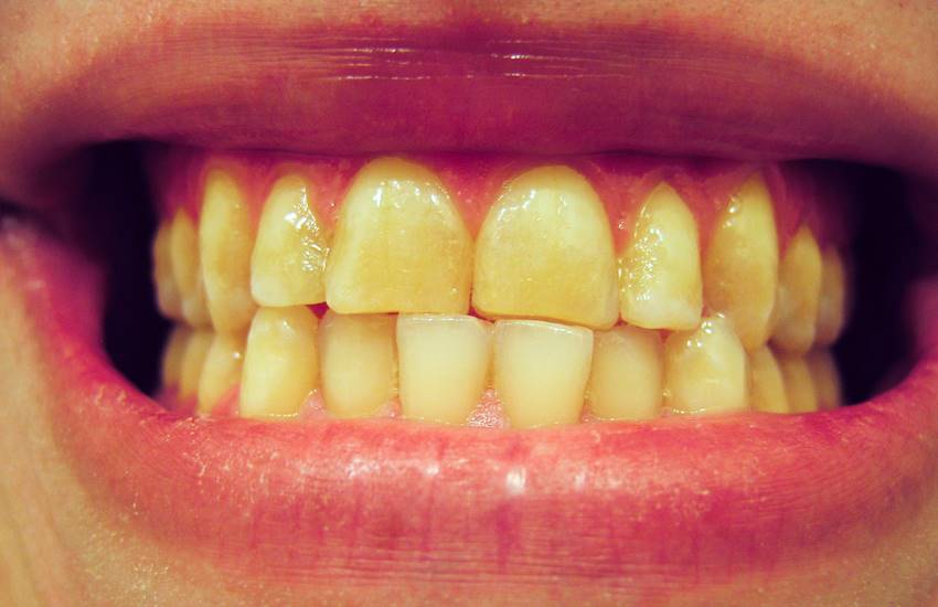 Как появляется желтый налет на зубах