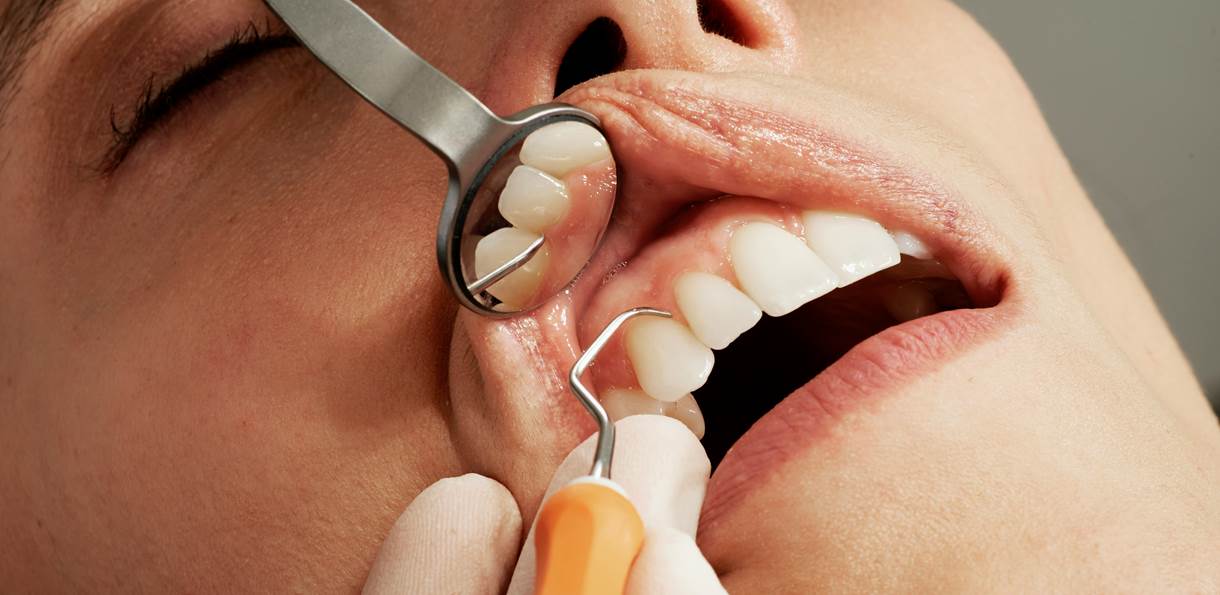 Клиновидный дефект зубов – что это и как лечить