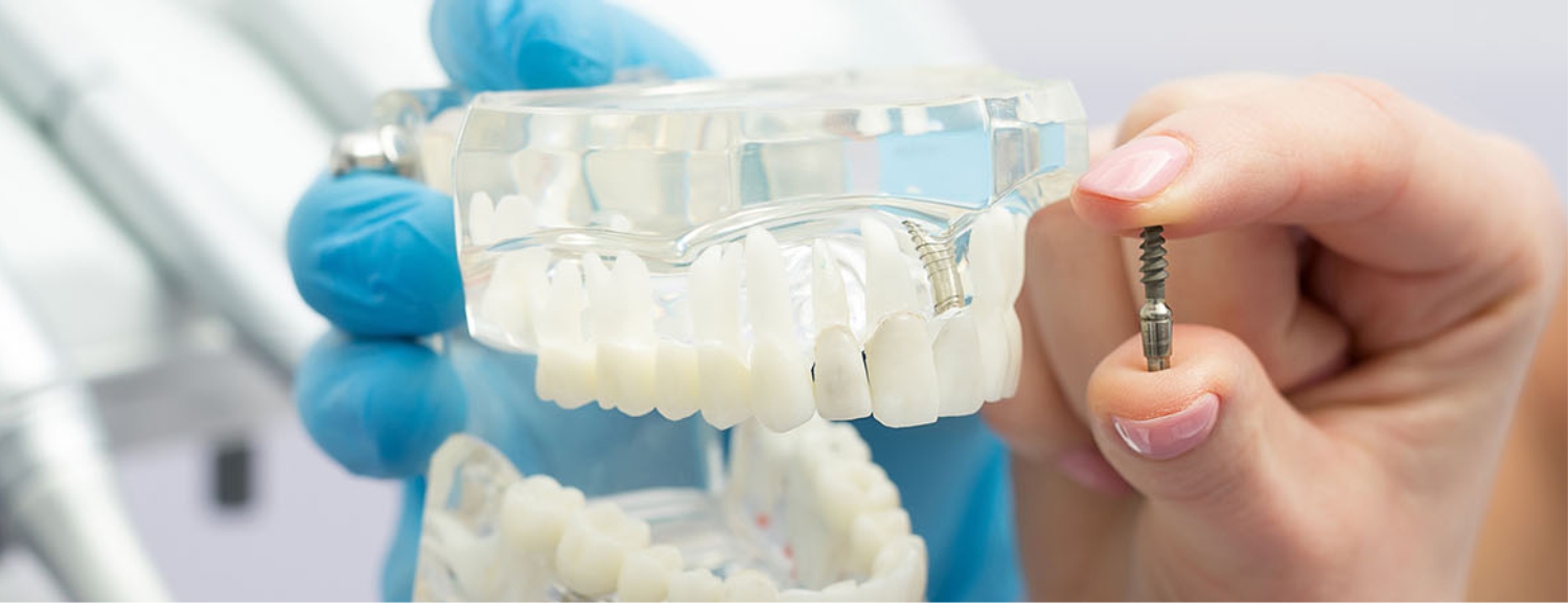 Мини-имплантация зубов: преимущества и недостатки
