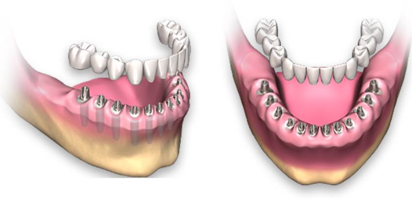 Методы восстановления нижних зубов