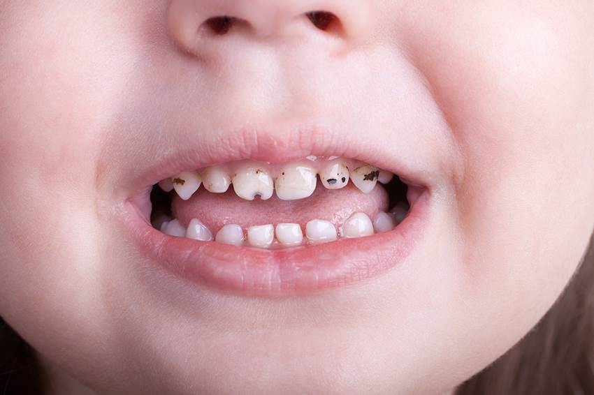 Темные пятна на зубах у детей