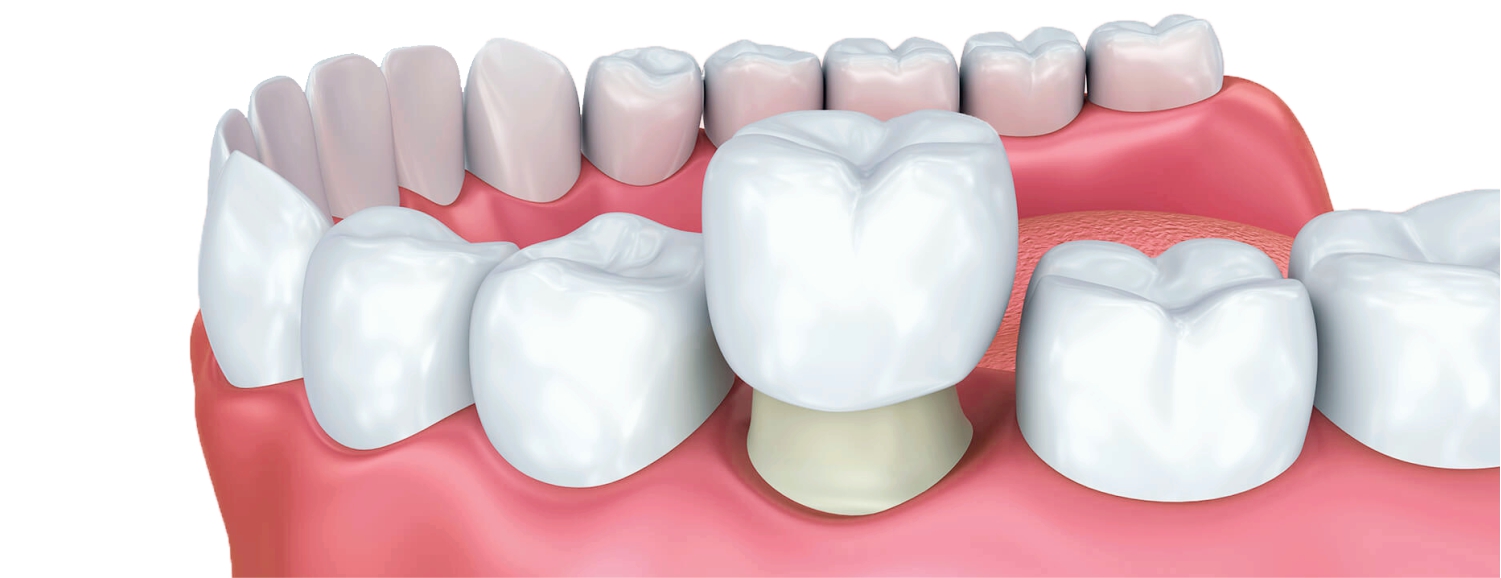 Коронка на живой зуб - можно ли ставить? Условия проведения процедуры, материалы и показания