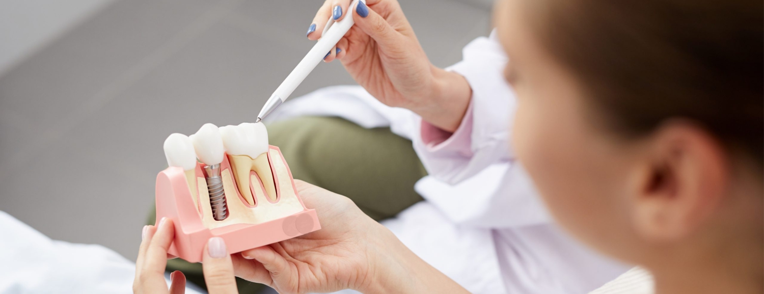 Имплантация одного зуба: почему не стоит пренебрегать этой процедурой?