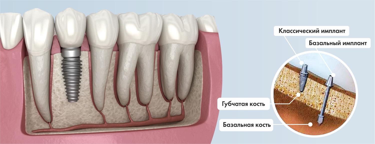 Дентальная имплантациязубов: виды и методики