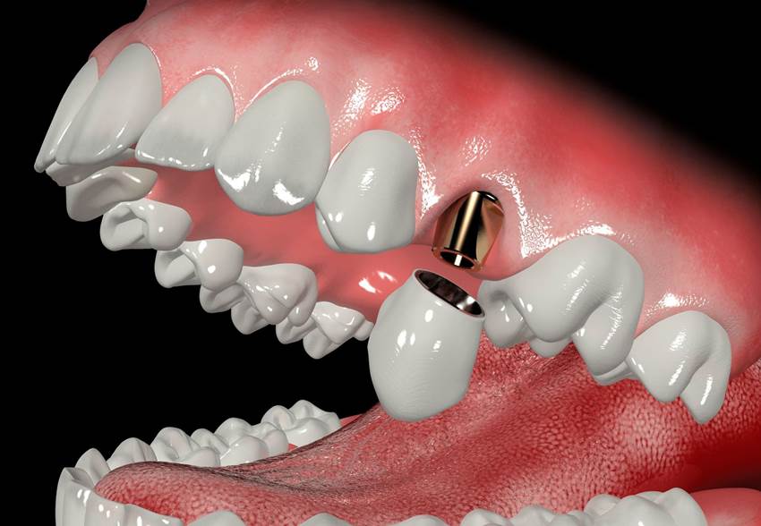 Способы восстановления верхних зубов