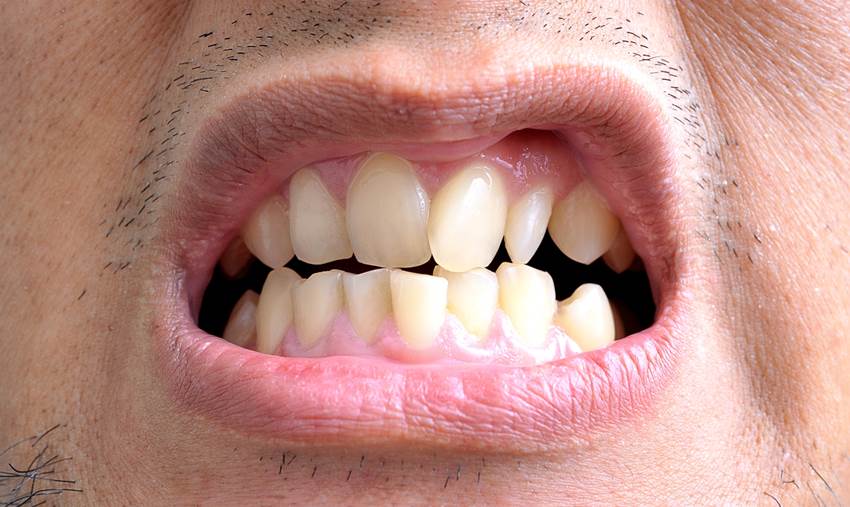 Шиповидные зубы