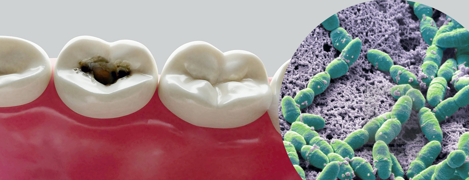 S.Mutans - как эти бактерии вызывают кариес и как этого избежать