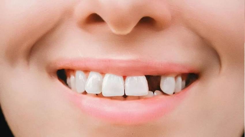 Часто задаваемые вопросы об отсутствии верхних зубов