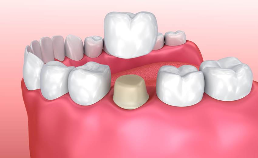 7 причин, почему может выпасть коронка зуба