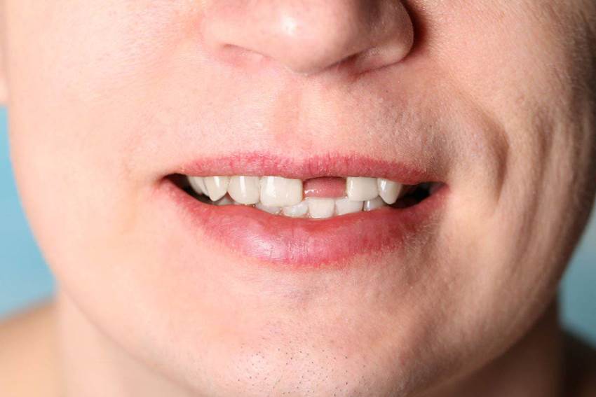 В чем проблема отсутствия верхних зубов