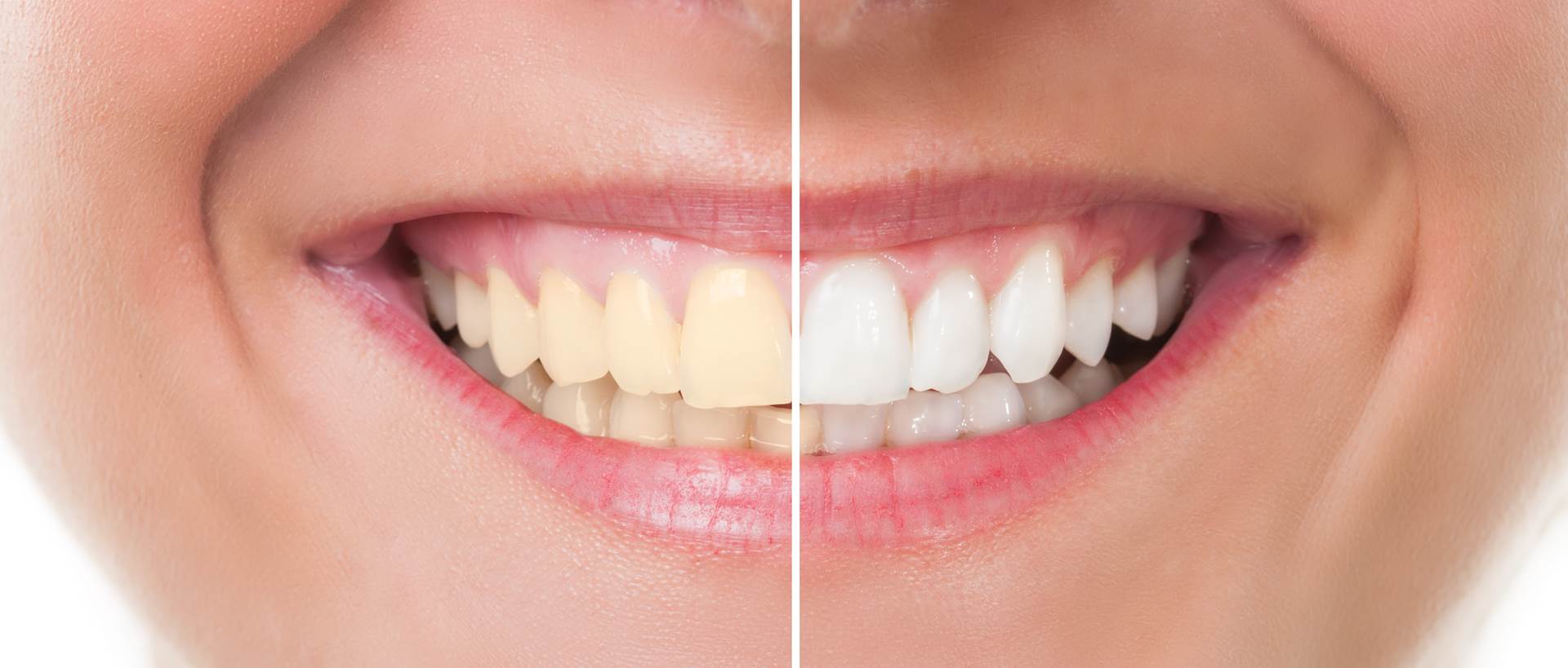 Как отбелить эмаль зубов: профессиональные способы