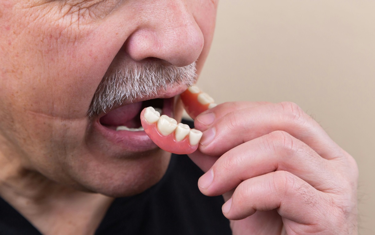 Чем заменить зубы: от временных протезов до имплантов