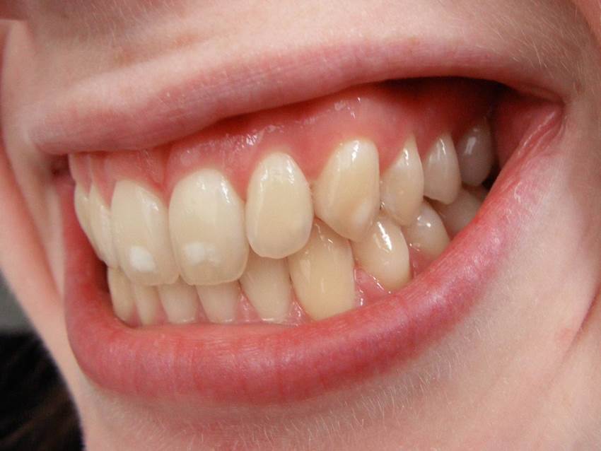 Что делает зубы некрасивыми