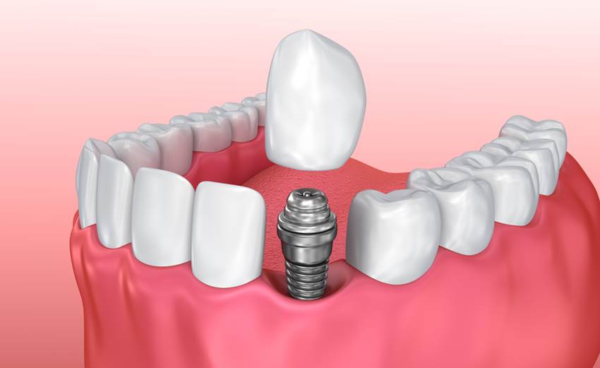 Виды одномоментной имплантации зубов