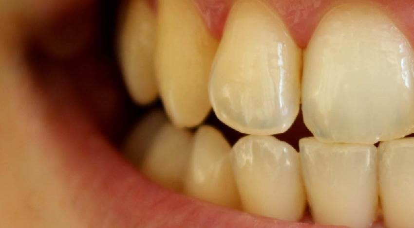 Общая характеристика тетрациклиновых зубов
