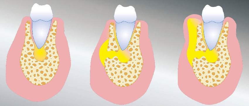 Общая характеристика абсцесса зуба