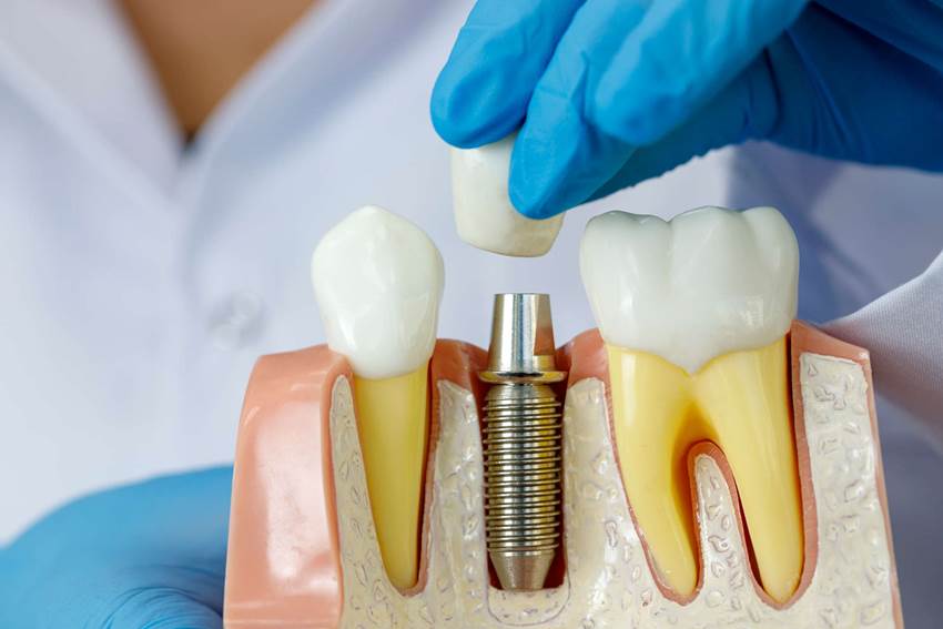 Что такое зубной имплант