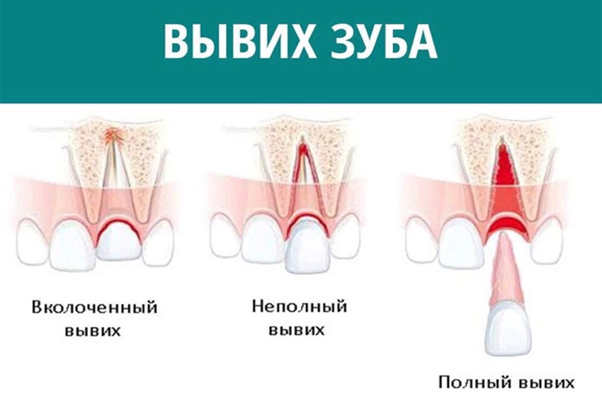 Классификация травм зуба