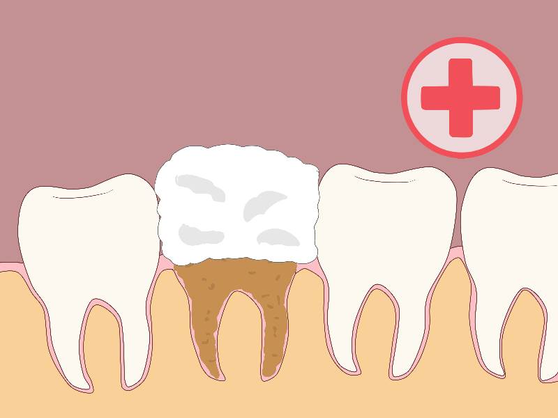 Что делать с кровотечением после удаления зуба
